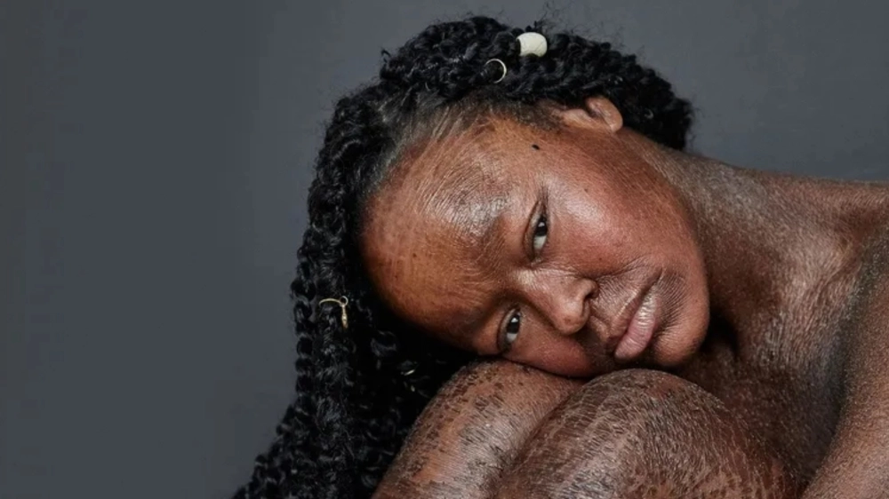 Thông tin về việc bệnh da rắn có di truyền không