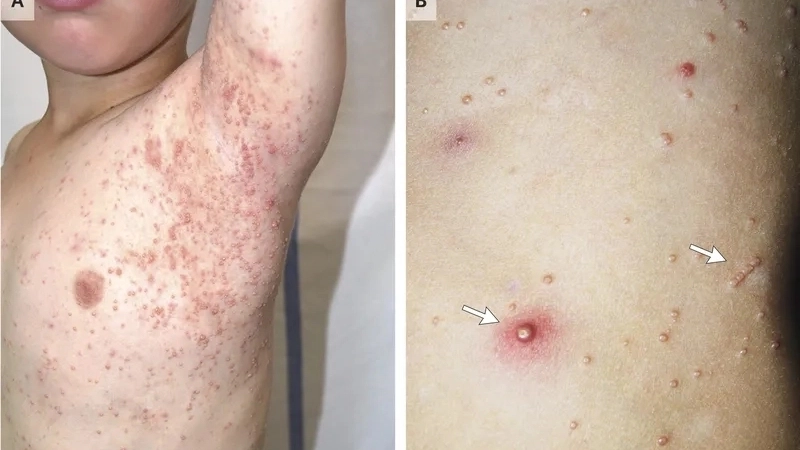 Hướng dẫn cách chữa bệnh đậu lào theo chỉ định bác sĩ