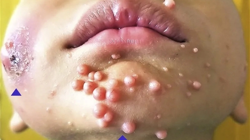 Phân biệt bệnh đậu lào và thủy đậu qua tổn thương da