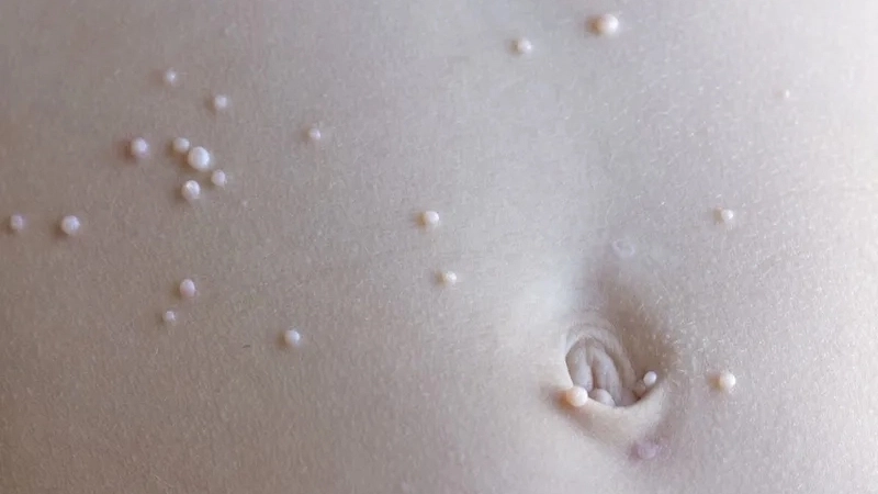 Phân biệt nốt phát ban của bệnh đậu mùa khỉ