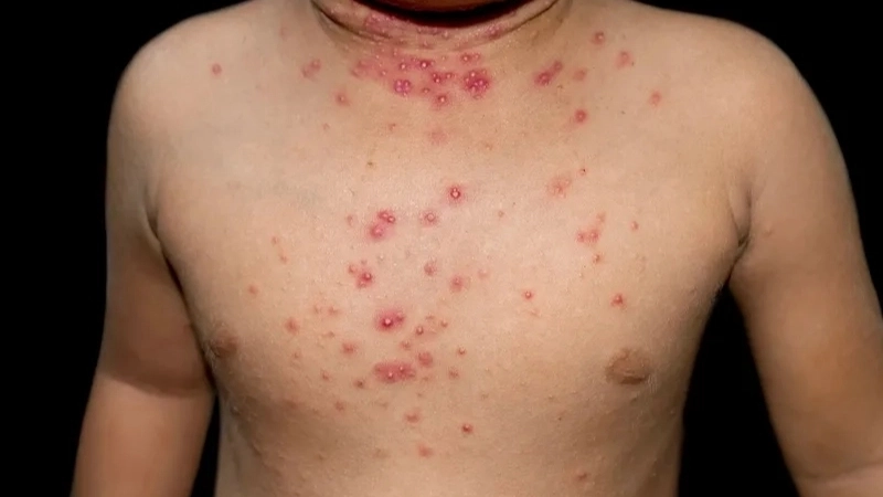 Tổng quan các triệu chứng bệnh đậu lào thường gặp