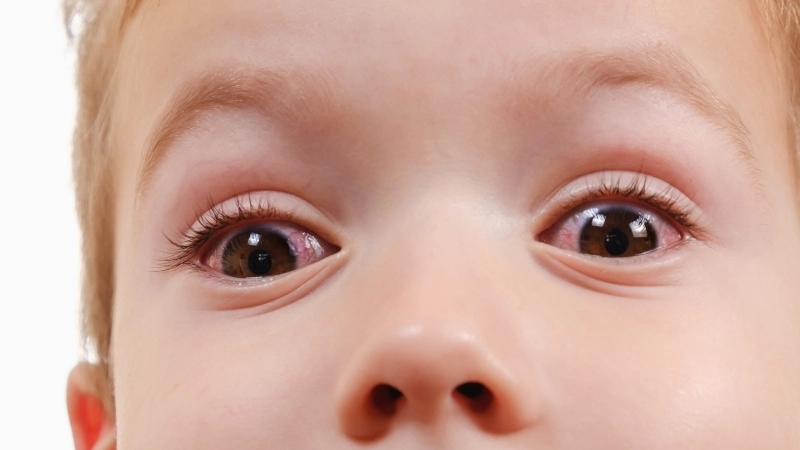 Dấu hiệu bệnh đau mắt đỏ ở trẻ em