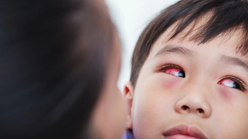 Cận cảnh hình ảnh mắt bị đỏ do viêm kết mạc