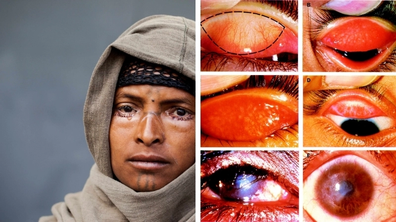 Các loại thuốc điều trị đau mắt hột dạng mỡ và uống