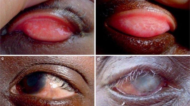 Con đường lây nhiễm trả lời cho câu hỏi bệnh đau mắt hột có lây không