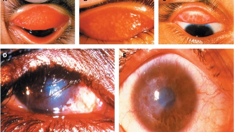 Hình ảnh vi khuẩn Chlamydia trachomatis dưới kính hiển vi