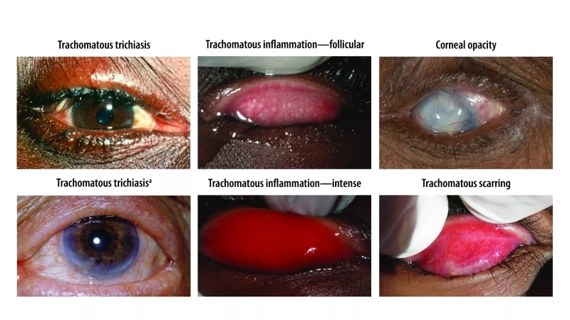 Các biến chứng của bệnh đau mắt hột gây sẹo giác mạc