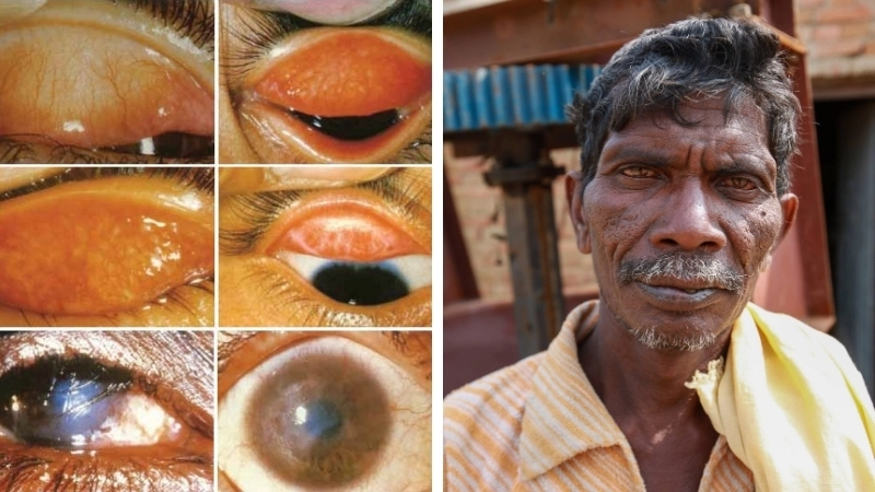 Tình trạng lông quặm, một biến chứng đau mắt hột nguy hiểm