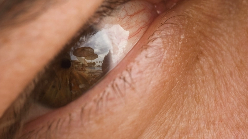 Hình ảnh giải thích bệnh đau mắt hột là gì với các hột và sẹo ở kết mạc mi