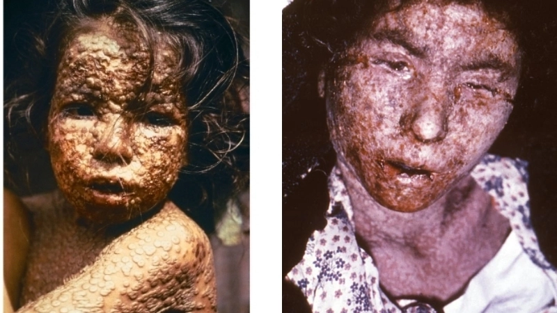 Bệnh đậu mùa khỉ hình ảnh các tổn thương đang đóng vảy