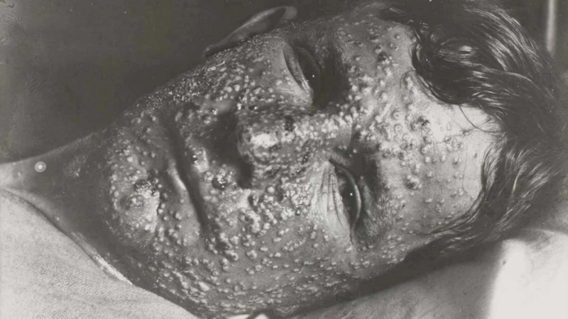 Các giai đoạn của hình ảnh bệnh đậu mùa khỉ từ dát sẩn đến mụn mủ