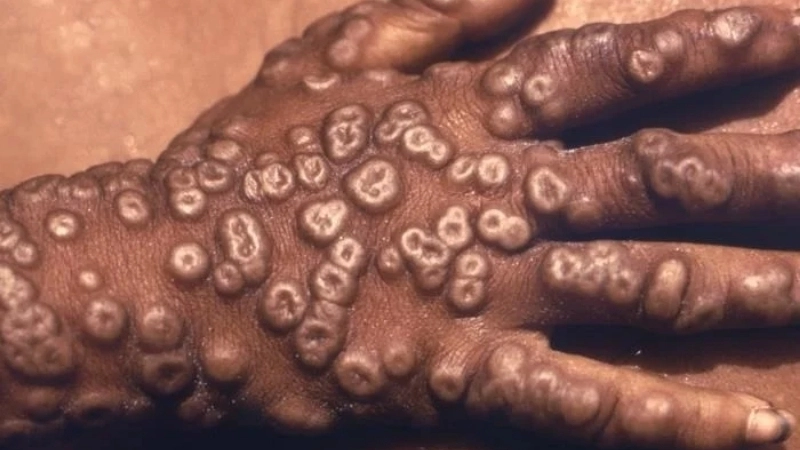 Hình đậu mùa khỉ ở giai đoạn phát ban đầu tiên