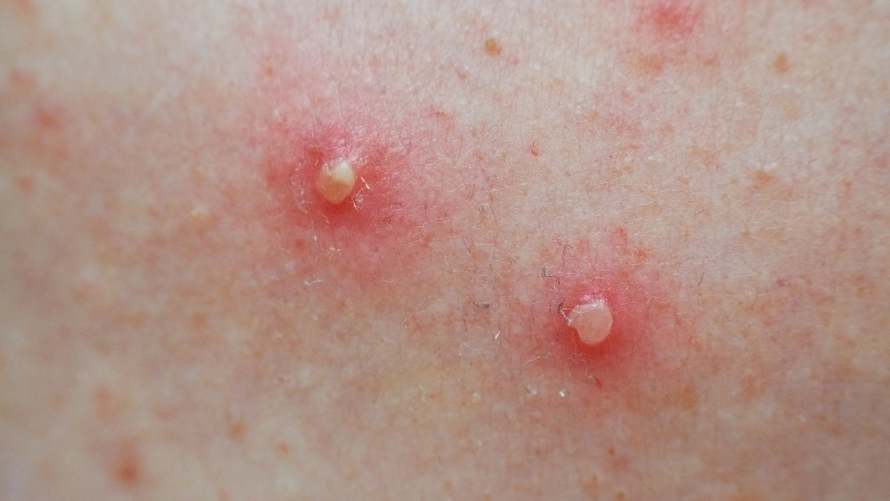 Tổng quan hình ảnh về bệnh đậu mùa khỉ trên cơ thể