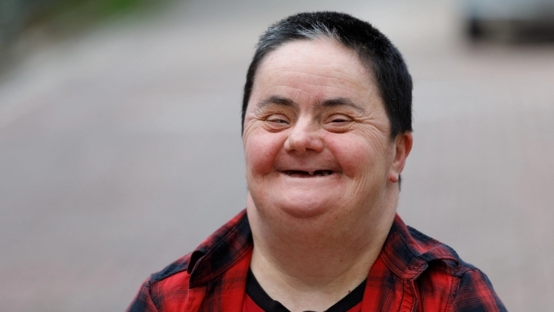 Hình ảnh người phụ nữ mắc chứng bệnh down 