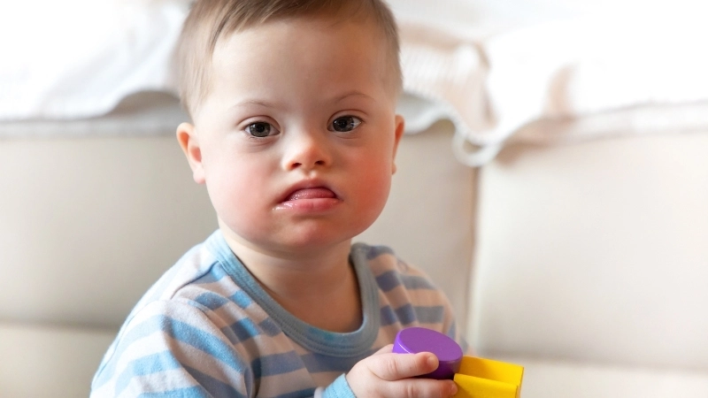 Biểu đồ nhiễm sắc thể minh họa cho hội chứng Down (Trisomy 21)