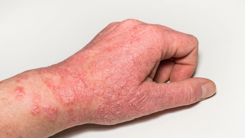 Sử dụng thuốc bôi trị eczema đúng cách