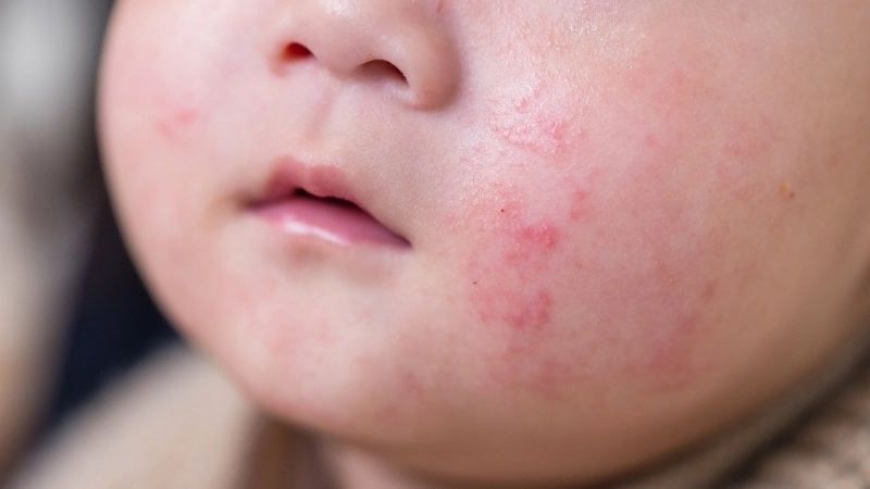 Thông tin y khoa về việc bệnh eczema có lây không