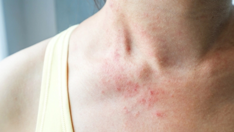 Tìm hiểu bệnh eczema kiêng ăn gì để mau khỏi