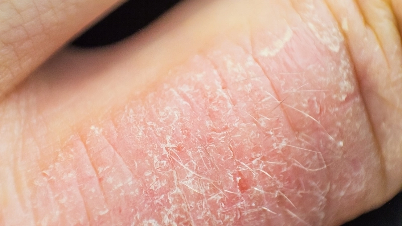 Cách phân biệt eczema và vảy nến qua hình ảnh