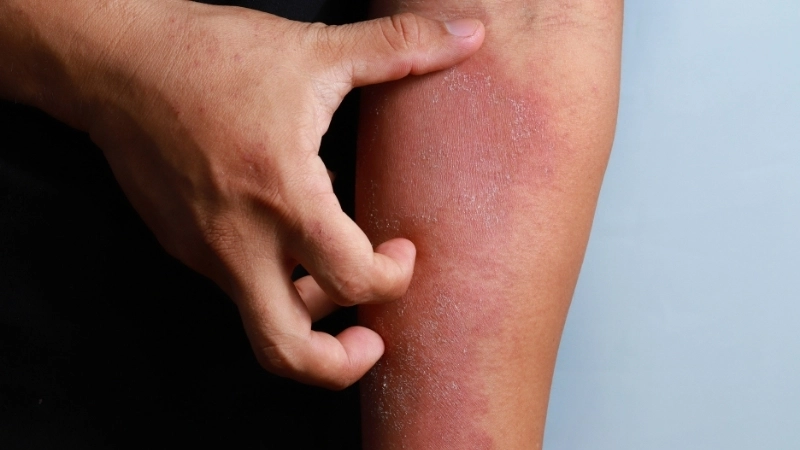 Dấu hiệu nhận biết eczema ở trẻ sơ sinh
