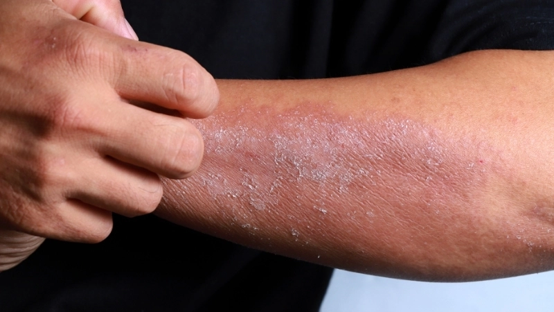 Biểu hiện của bệnh eczema ở tay