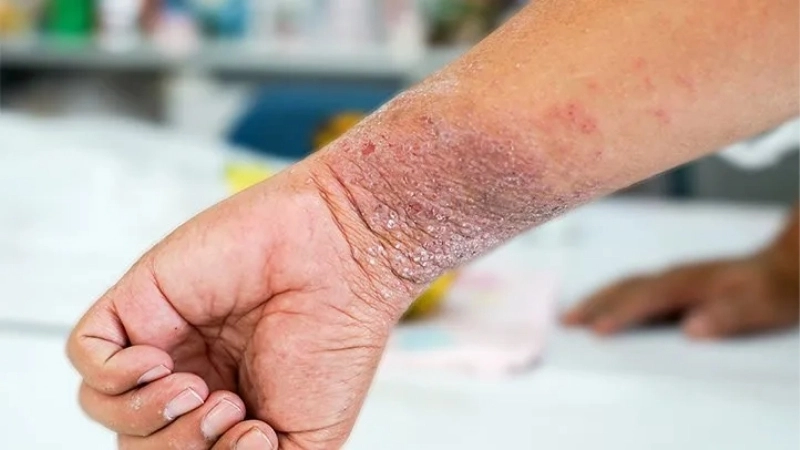 Tình trạng da bị eczema khô nứt nẻ