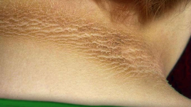 Mối liên hệ giữa bệnh gai đen và tiểu đường qua hình ảnh