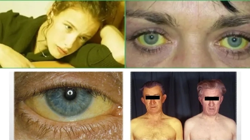 So sánh hình ảnh các bệnh về gan phổ biến