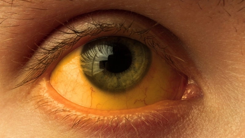 Hình ảnh khối u trong bệnh ung thư gan