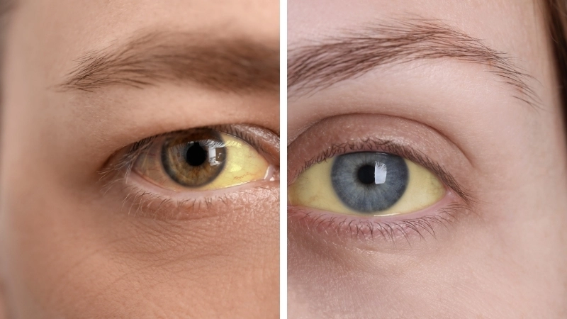 Cảnh báo về chỉ số men gan cao