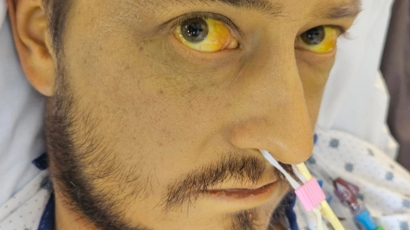 Hình ảnh nổi mẩn ngứa do gan, một dấu hiệu cảnh báo sớm