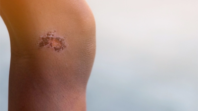 Đường hầm ghẻ và sẩn ngứa điển hình trên hình ảnh bệnh ghẻ.