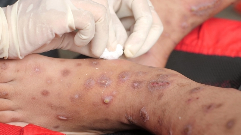 Hình ảnh ghẻ ở bìu gây ngứa ngáy khó chịu