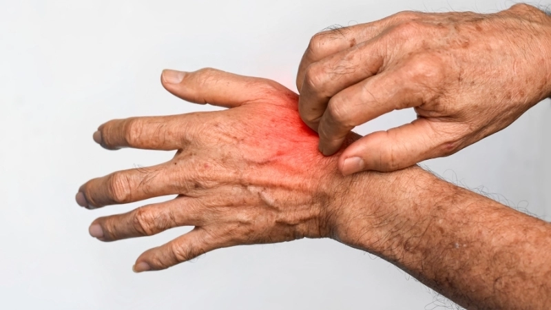 Tổn thương da ở mông hình ảnh bệnh ghẻ ngứa