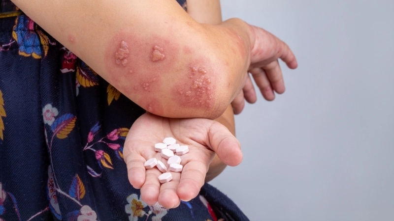 Cận cảnh hình ảnh con ghẻ ngứa dưới kính hiển vi