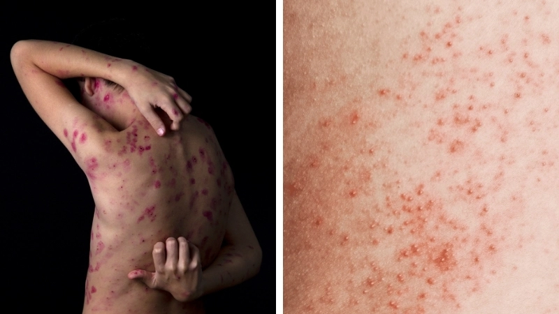 Hình ảnh ghẻ ở kẽ ngón tay điển hình