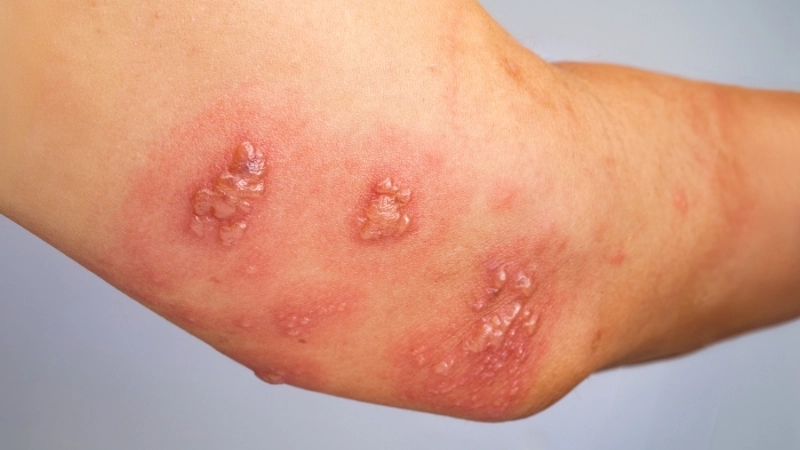 Cận cảnh hình ảnh bệnh ghẻ nước với các mụn nước nhỏ li ti