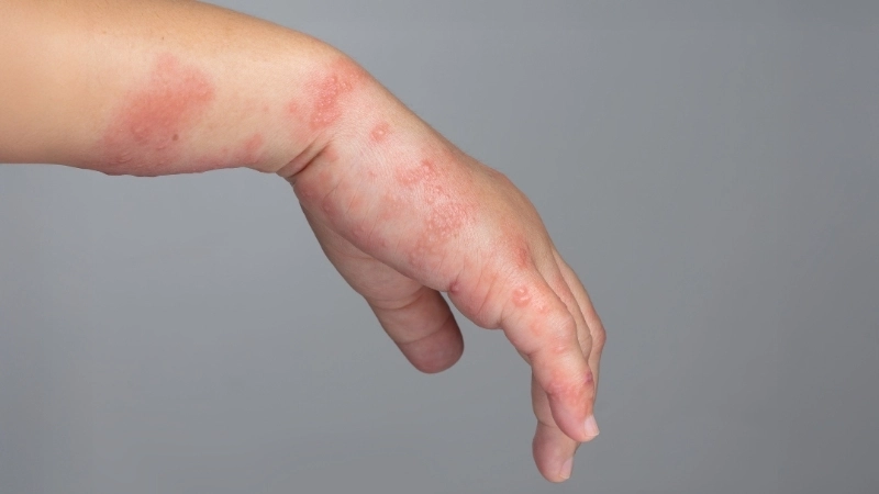 Hướng dẫn cách trị ghẻ ngứa ở trẻ an toàn