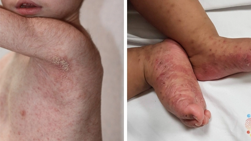 Cách phân biệt ghẻ và rôm sảy qua hình ảnh