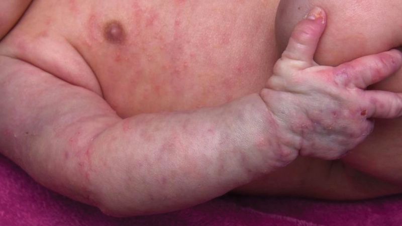 Biểu hiện của bệnh ghẻ nước ở trẻ em