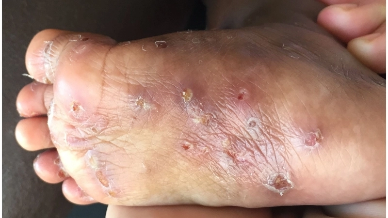 Các loại kem trị ghẻ cho bé hiệu quả