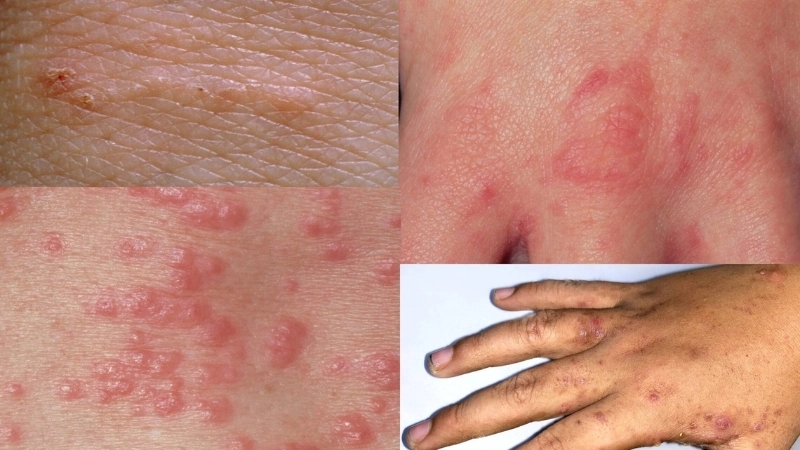 Luống ghẻ điển hình - một dấu hiệu bệnh ghẻ ở trẻ em