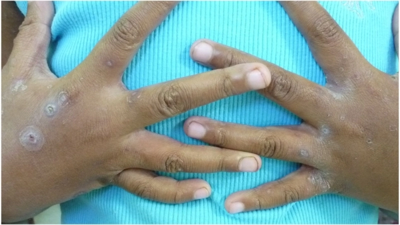 Hình ảnh mụn nước trong bệnh ghẻ nước ở trẻ em