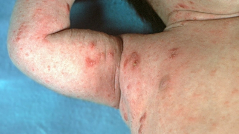 Các loại thuốc bôi ghẻ cho bé theo từng độ tuổi