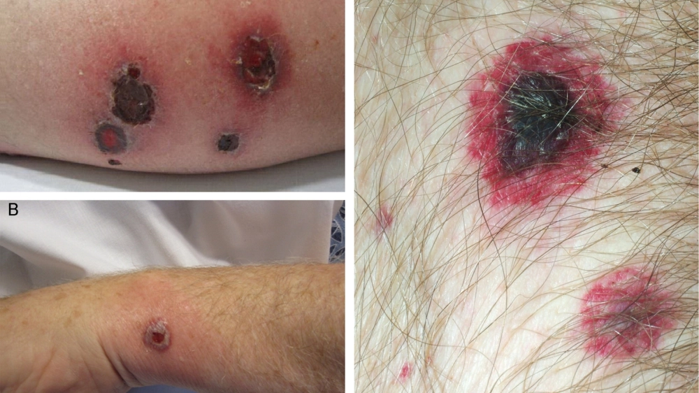 Hướng dẫn cách trị ghẻ ruồi bằng thuốc kháng sinh tại chỗ