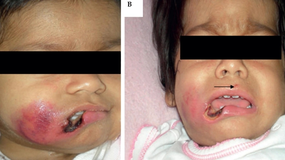 Một số loại thuốc bôi ghẻ ruồi được bác sĩ khuyên dùng