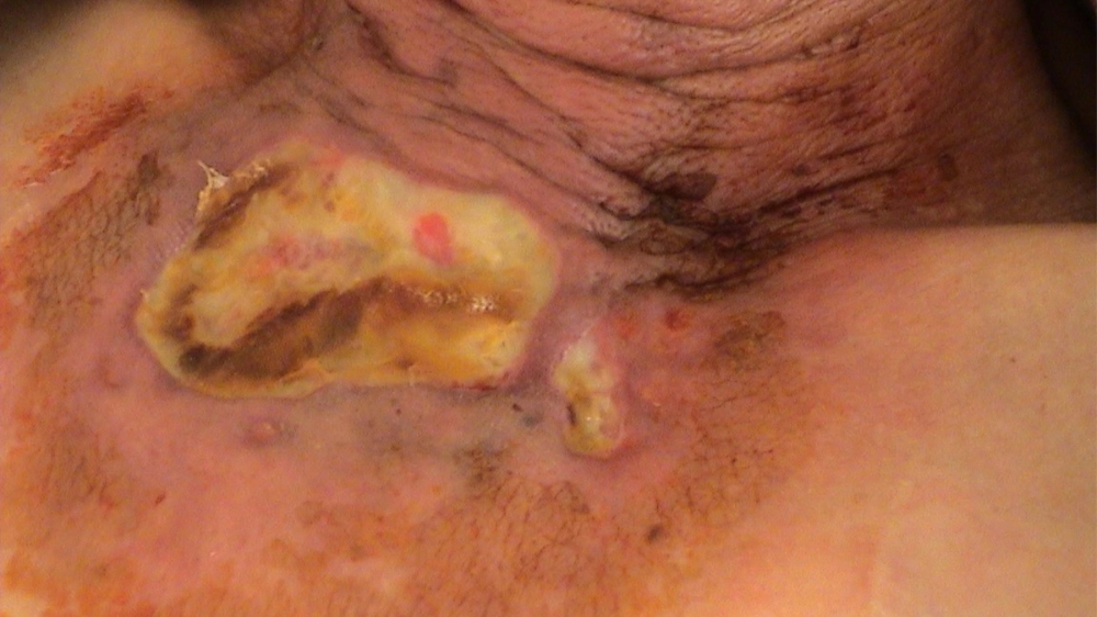 Bảng so sánh để phân biệt ghẻ ruồi và mụn nhọt