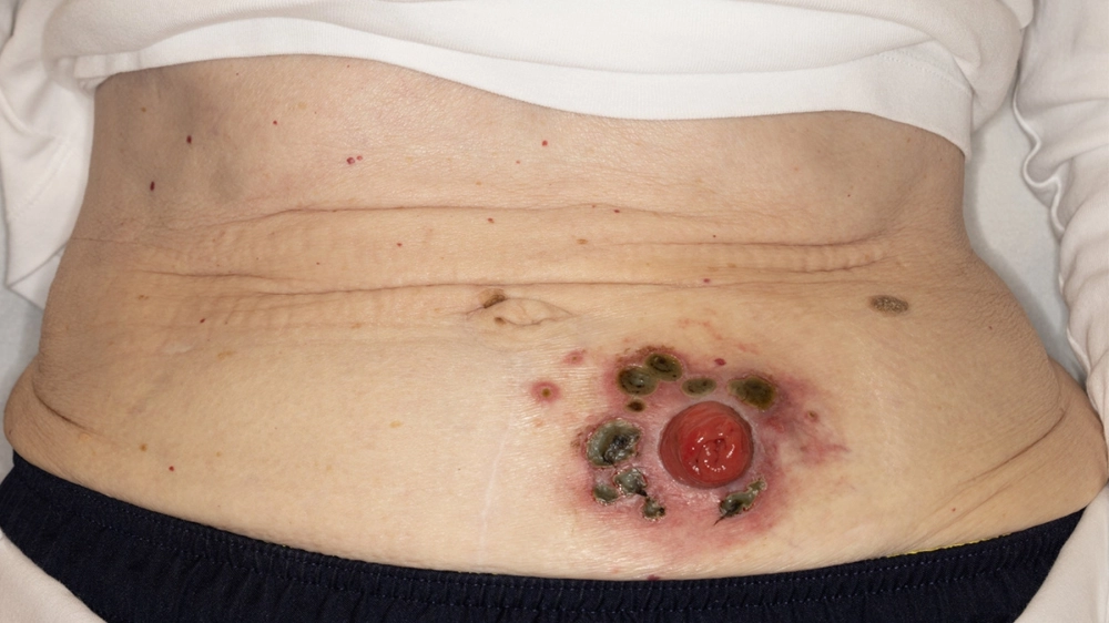 Hình ảnh tổn thương do ghẻ ruồi ở mông và chân