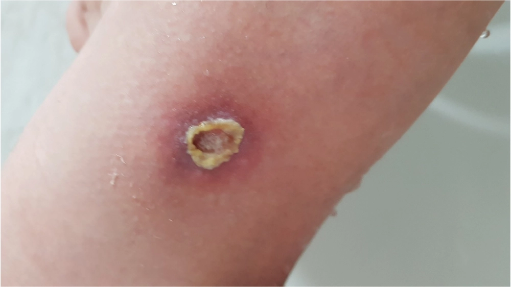 Giải đáp ghẻ ruồi có lây không qua tiếp xúc trực tiếp