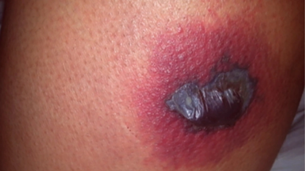 Vết sẹo thâm sau khi điều trị ghẻ ruồi không đúng cách